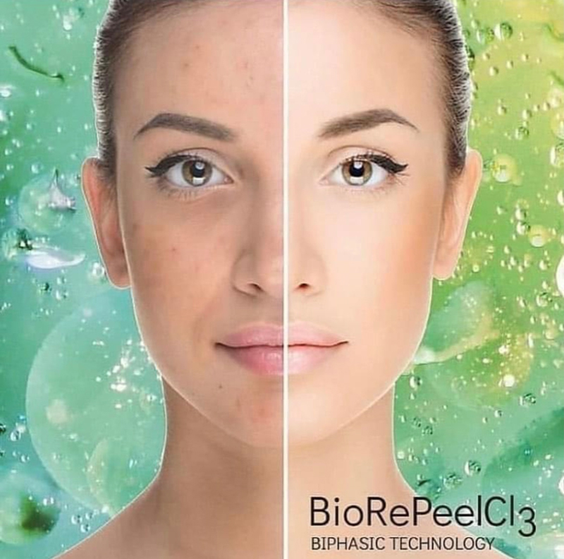 Chemical Skin Peel (BioRePeel Acid Peel) treatment at Amara Aesthetics